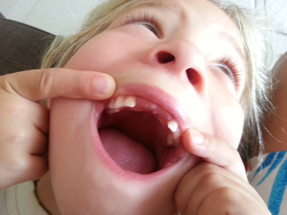 20130321_142945_Neuer_Zahn